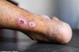 هشدار درباره شیوع یک بیماری پوستی خطرناک در استرالیا